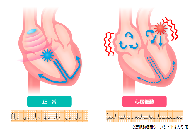 アブレーション カテーテル 不整脈（カテーテルアブレーション）の名医・専門医リスト